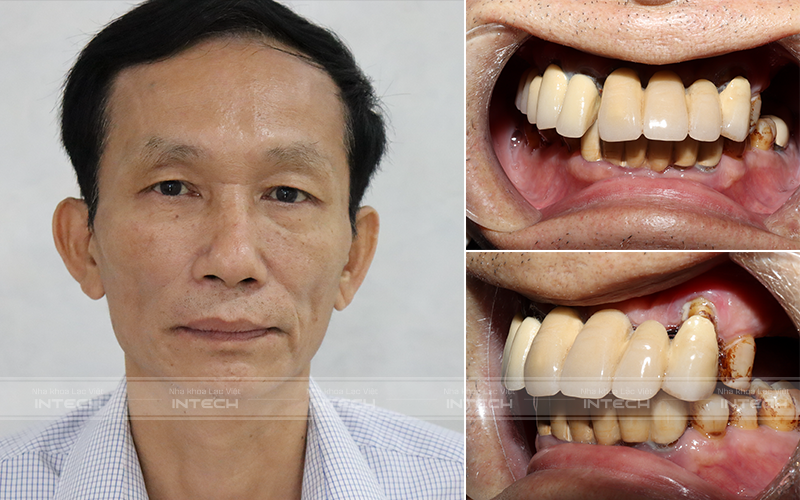 Tình trạng trước đây của khách hàng Đào Khắc Phương (60 tuổi)
