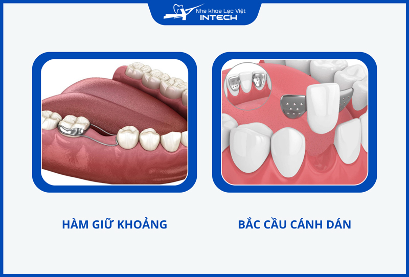 Nếu chưa đủ tuổi cấy ghép Implant, trẻ em có thể dùng các biện pháp thay thế để ngăn các biến chứng khi mất răng lâu năm