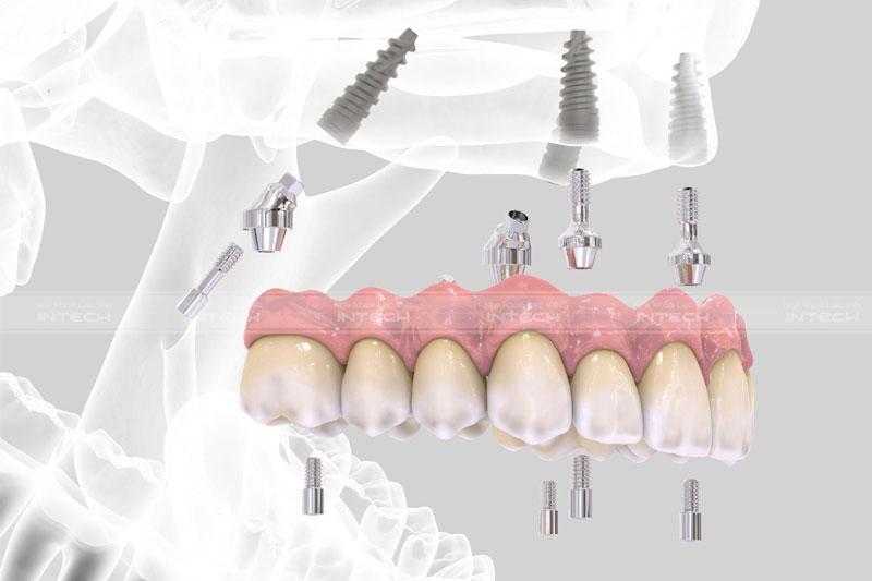 Kỹ thuật trồng răng All-On-4 không cần phải ghép xương