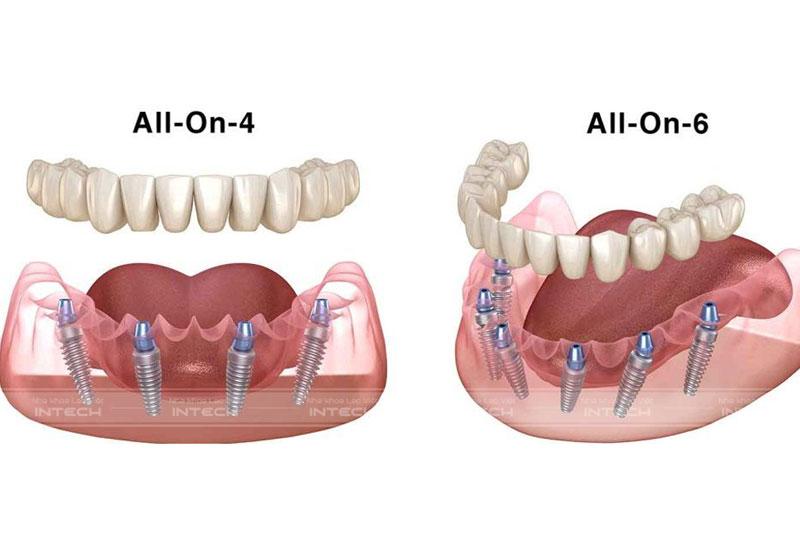 Trồng răng All On 4 và All On 6 đem lại khả năng ăn nhai hoàn hảo, tuổi thọ lâu dài