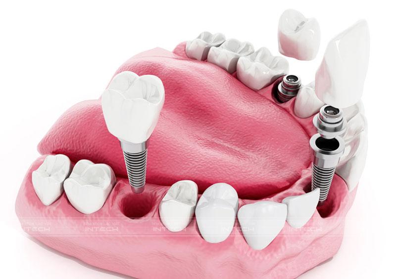 Phương pháp trồng răng Implant đơn lẻ đối với trường hợp mất nhiều răng tại vị trí khác nhau