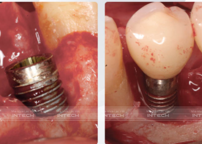 Trồng răng implant giá rẻ có thể gây ra nhiều biến chứng