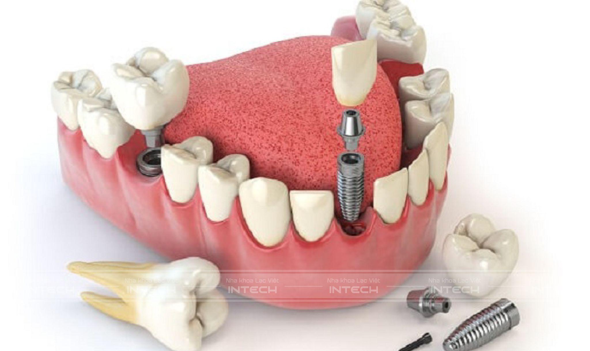Trồng răng Implant trồng răng toàn bộ hàm