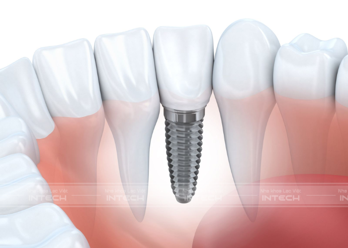Trồng răng implant không ảnh hưởng đến răng thật xung quanh
