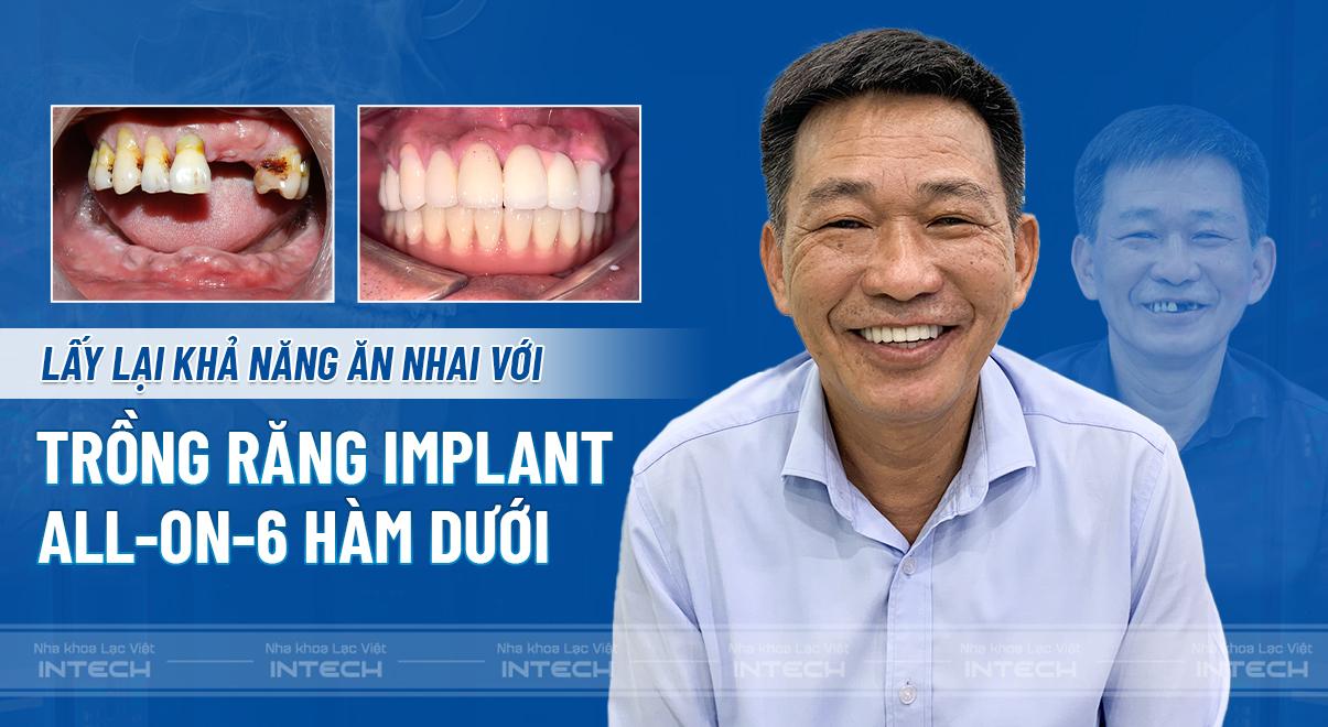 Lấy lại khả năng ăn nhai với trồng răng Implant All-on-6 toàn hàm dưới