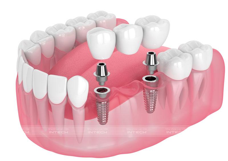 Phương pháp trồng răng bắc cầu áp dụng cho trường hợp mất nhiều răng liền kề