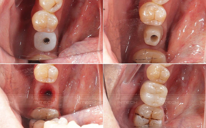 Giải pháp trồng răng cá nhân hóa được áp dụng thường quy tại Lạc Việt Intech