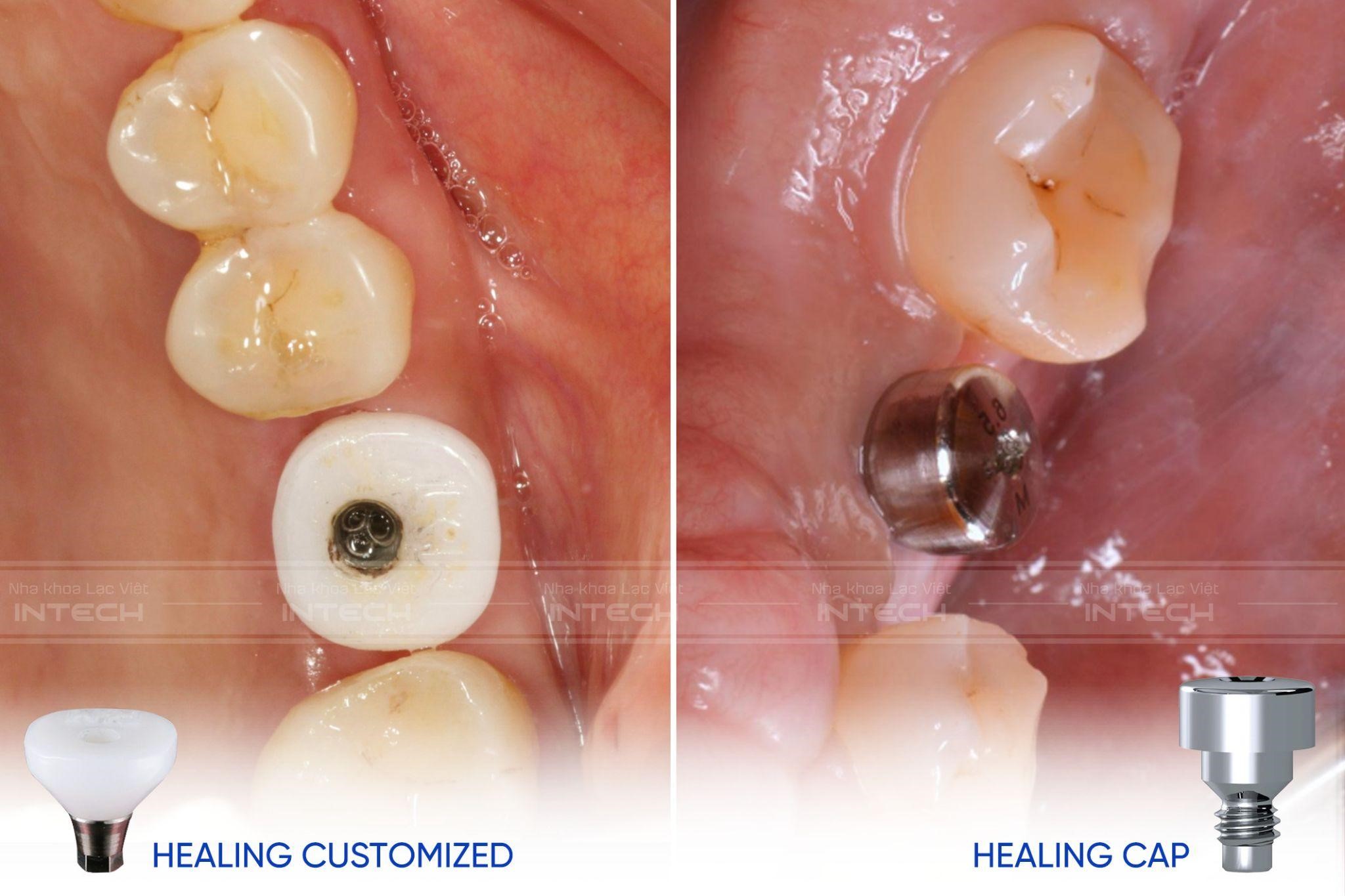 Thay vì sử dụng trụ lành thương bán sẵn, nha khoa uy tín Hải Phòng - Lạc Việt Intech ứng dụng đồng bộ trụ lành thương cá nhân hóa.
