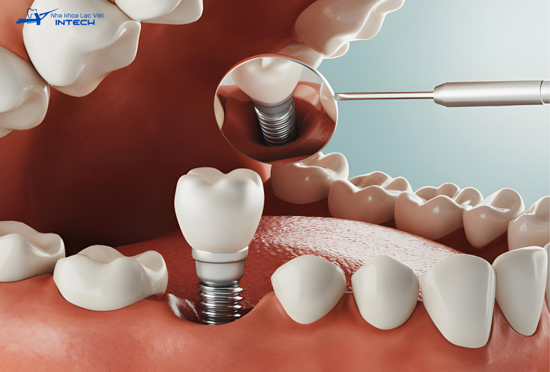 Trồng răng cấm Implant giá bao nhiêu? Chi tiết bảng giá