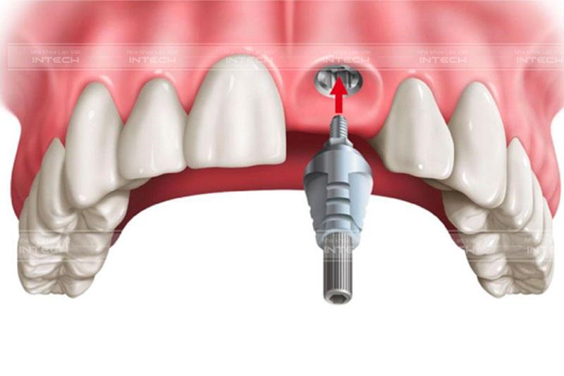 Kỹ thuật trồng răng Implant áp dụng cho các trường hợp bị mất răng cửa 