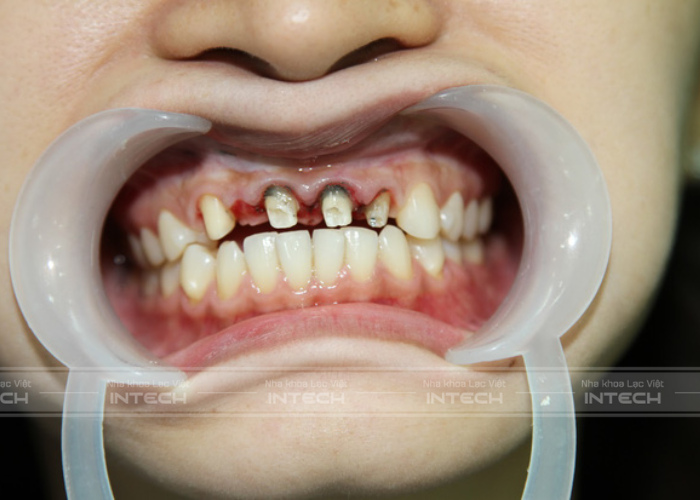 Trồng răng implant giá rẻ gây ra biến chứng nguy hiểm sau phẫu thuật
