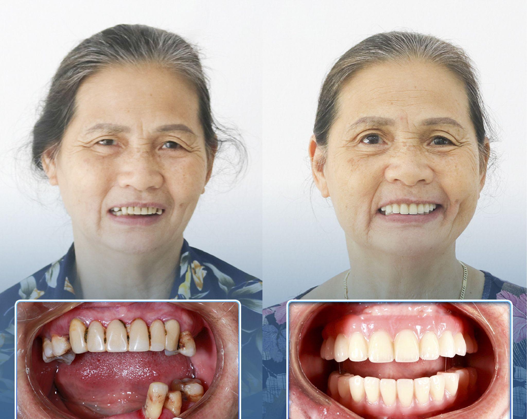 Trồng răng hàm bằng cấy ghép Implant