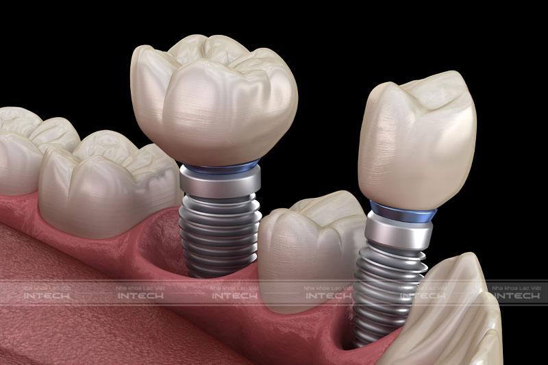 Trồng răng hàm bằng cấy Implant