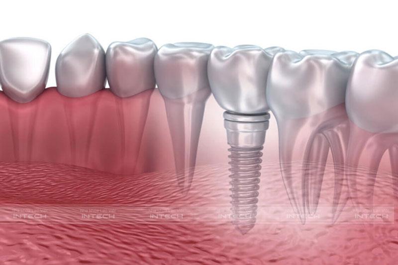 Trồng răng Implant giúp ngăn chặn tình trạng tiêu xương