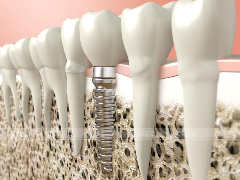 Trồng răng Implant giúp ngăn chặn tiêu xương hiệu quả