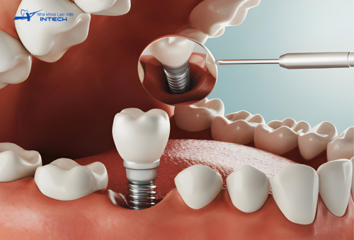 Giải đáp thắc mắc trồng răng Implant có được bảo hiểm không?