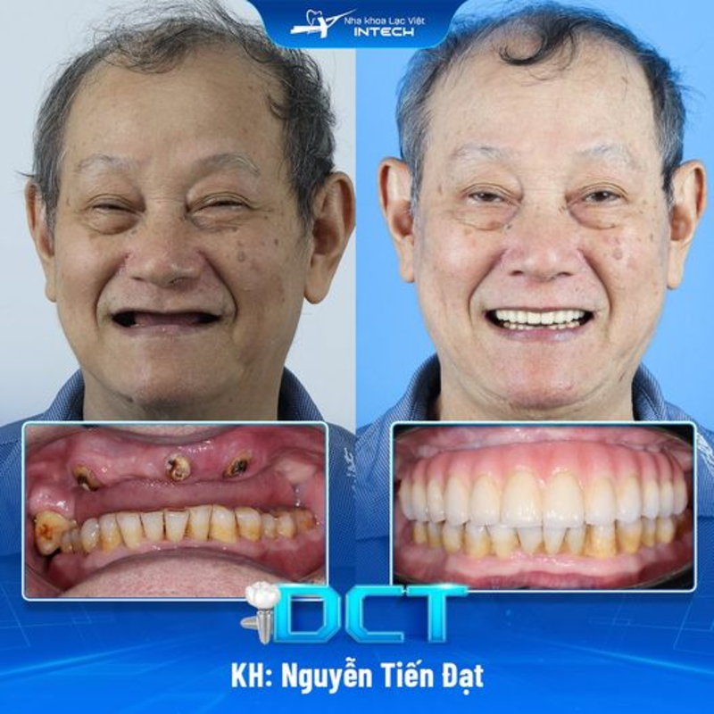 Trồng răng Implant có chi phí tương đối cao và sử dụng vật tư y tế thay thế nên không nhận được chi phí hỗ trợ từ bảo hiểm nhân thọ