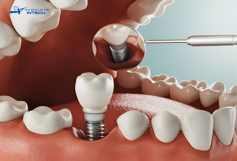 Trồng răng Implant sẽ không được hỗ trợ chi phí từ bảo hiểm y tế