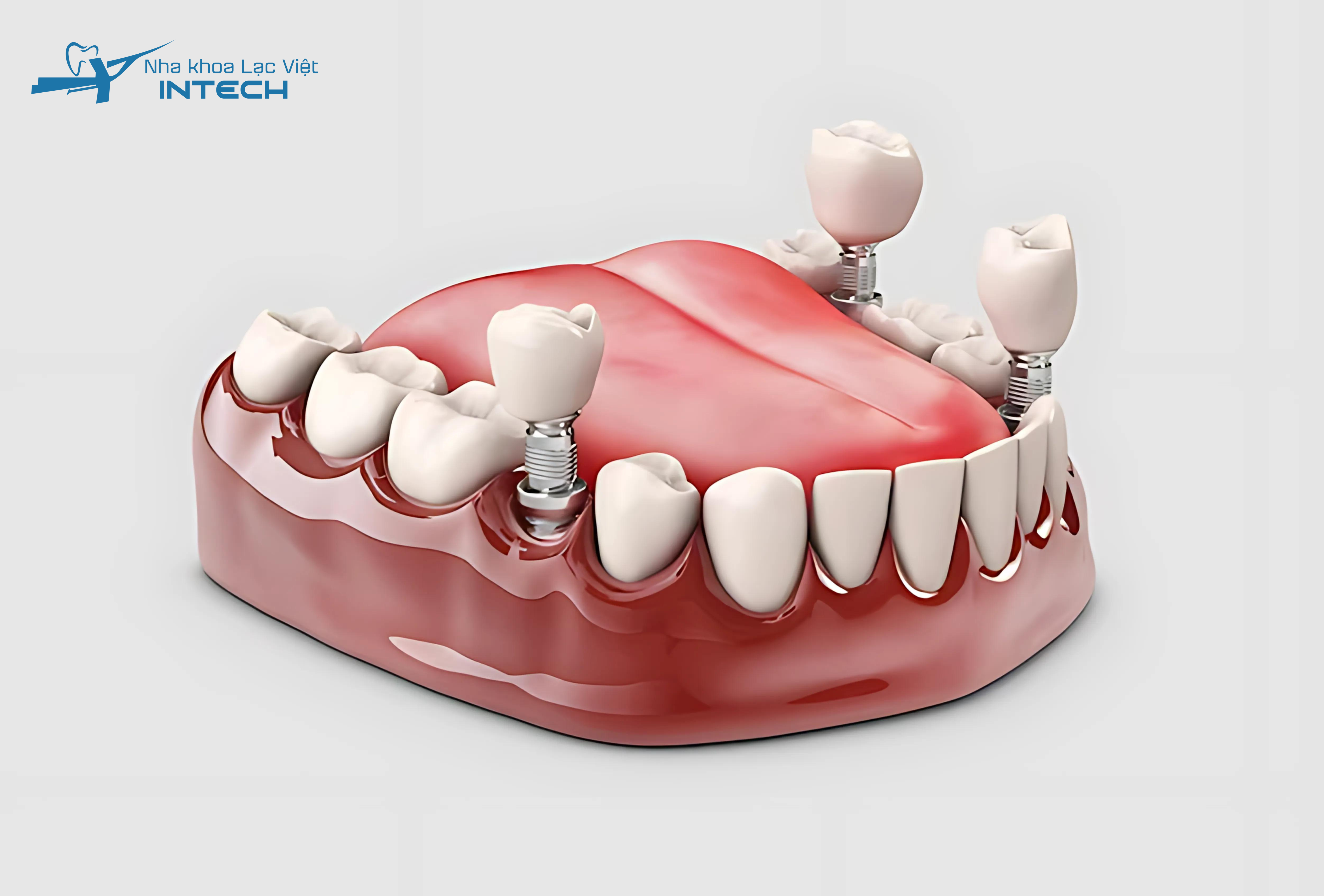 Trồng răng Implant còn tồn tại một số nhược điểm tuy nhiên mang nhiều ưu điểm vượt trội