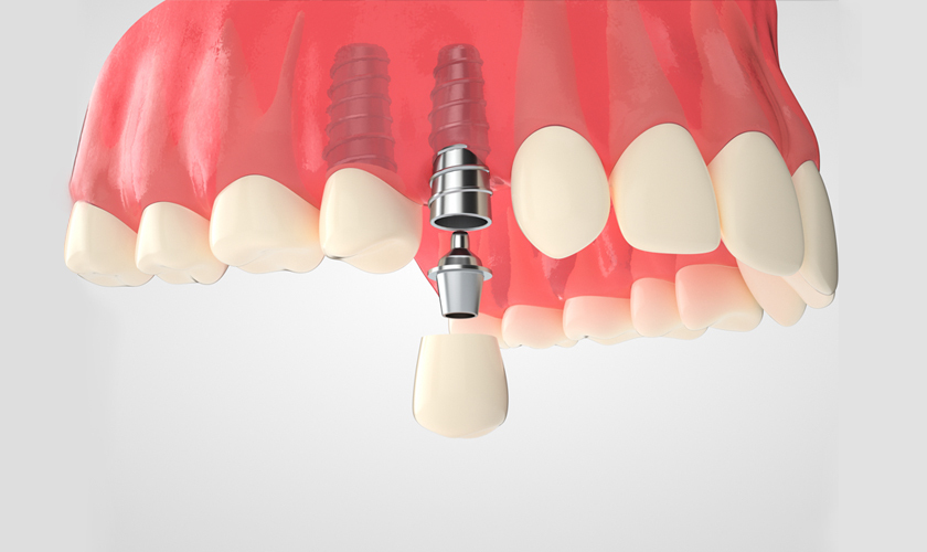  Trồng răng implant đơn lẻ
