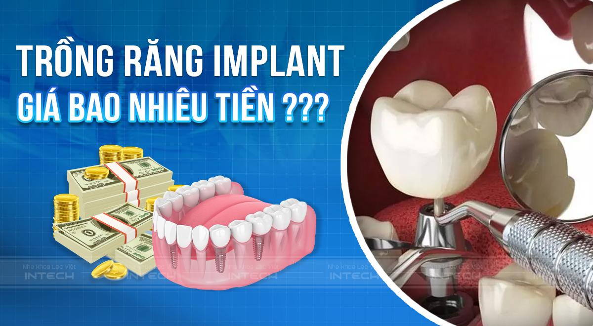 Giá cấy răng Implant là bao nhiêu?