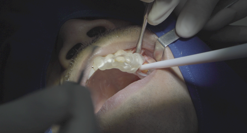 Giá trồng răng Implant tại Nha khoa Lạc Việt Intech đã bao gồm trụ Implant, trụ phục hình và mão răng sứ