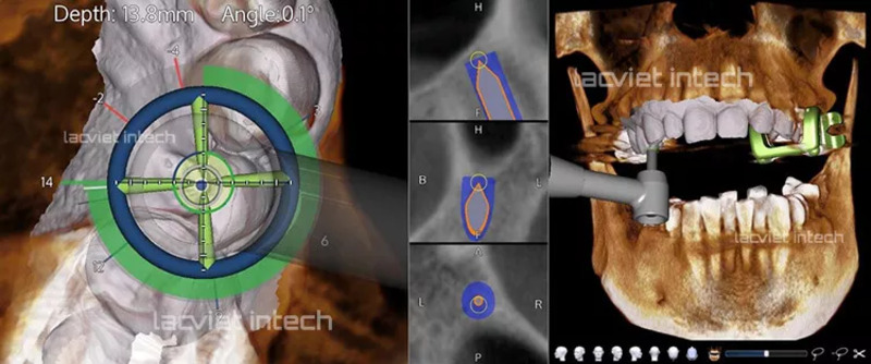 Trồng Implant bằng Robot X-Guide có khả năng định vị tọa độ chính xác vị trí cần đặt trụ