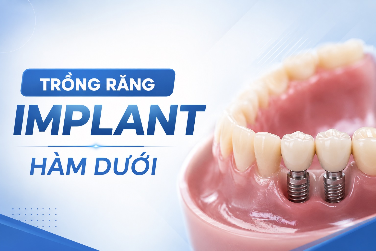 Trồng răng Implant hàm dưới: Quy trình, chi phí, rủi ro và những điều cần biết