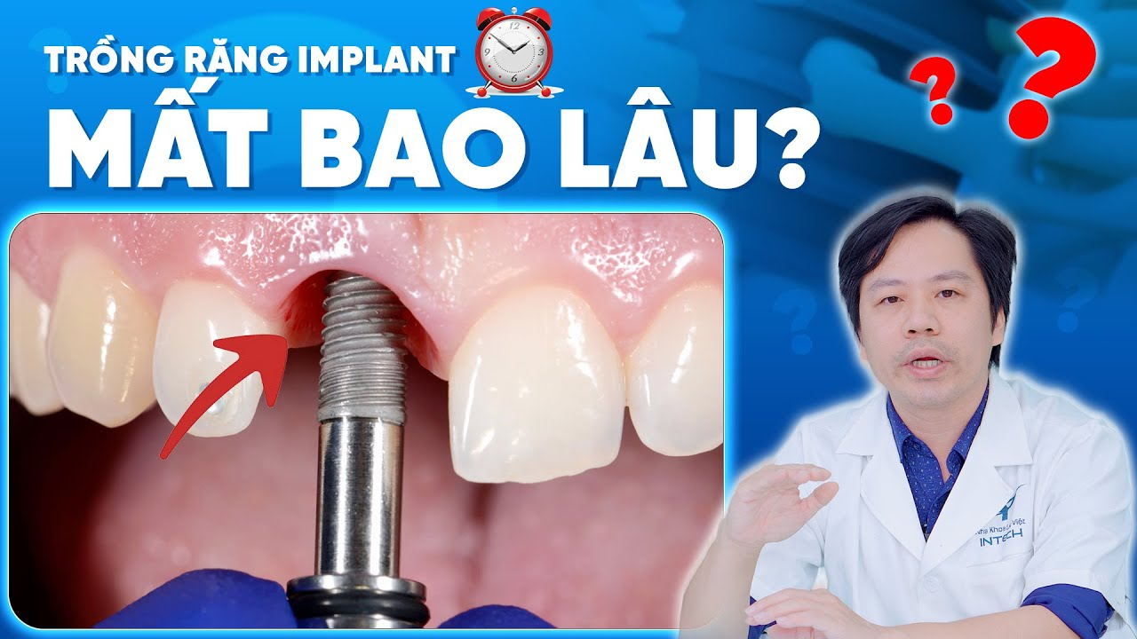 Trồng răng Implant kéo dài hơn so với bắc cầu răng sứ hay hàm tháo lắp do cần thời gian để trụ Implant tích hợp