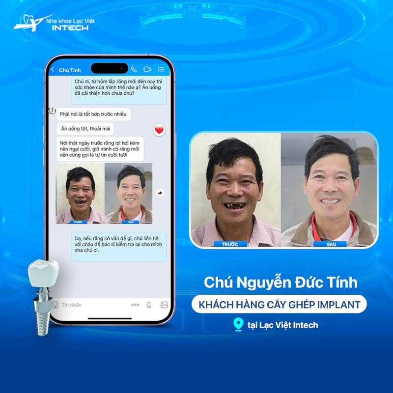 Review về trải nghiệm trồng răng Implant thực tế tại Nha khoa Lạc Việt Intech của chú Nguyễn Đức Tính