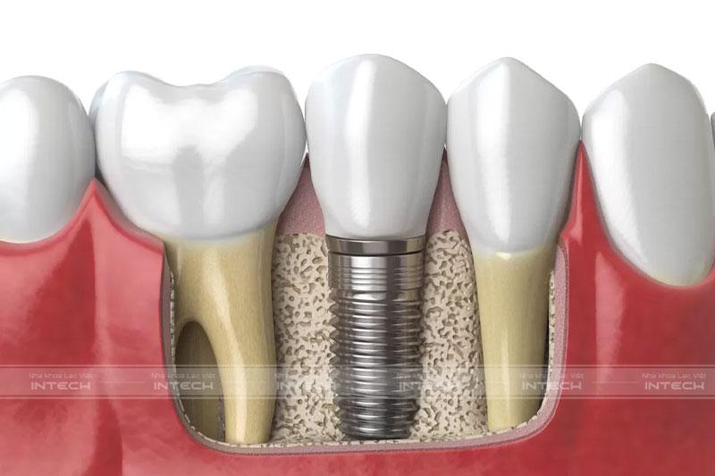 Phương pháp trồng răng Implant không cần lấy tủy