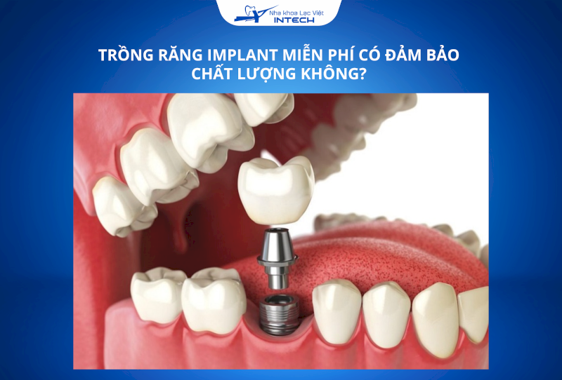 5 dịch vụ trồng răng Implant miễn phí, tiết kiệm hàng triệu đồng