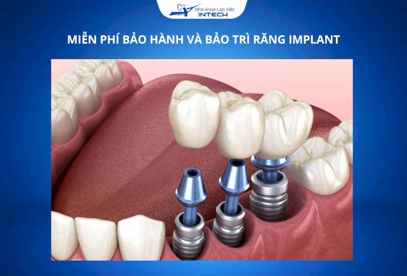 Chính sách bảo hành trụ Implant tùy theo loại trụ, giúp cô chú/anh chị yên tâm về độ bền của răng Implant