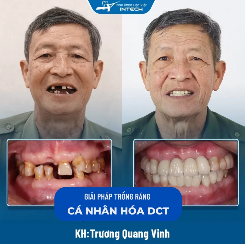 Bảng giá trồng răng Implant ở Hải Phòng mới nhất 2025