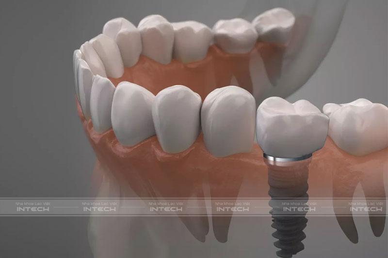 Trồng Implant răng số 6