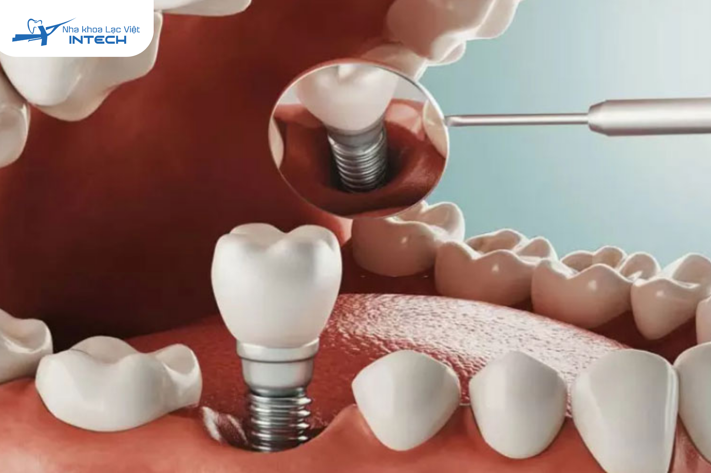 Trồng răng Implant là giải pháp thay thế răng mất hiệu quả nhất giải quyết tình trạng răng bị giắt thức ăn 