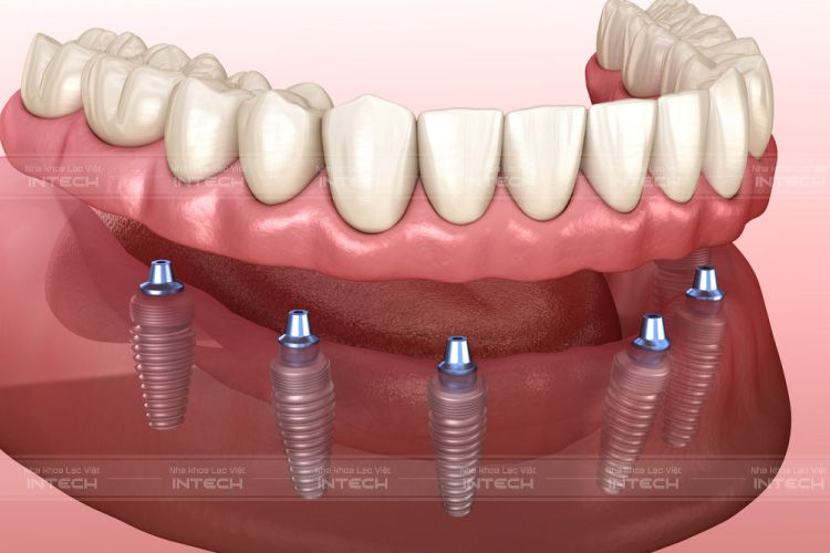 Trồng răng Implant