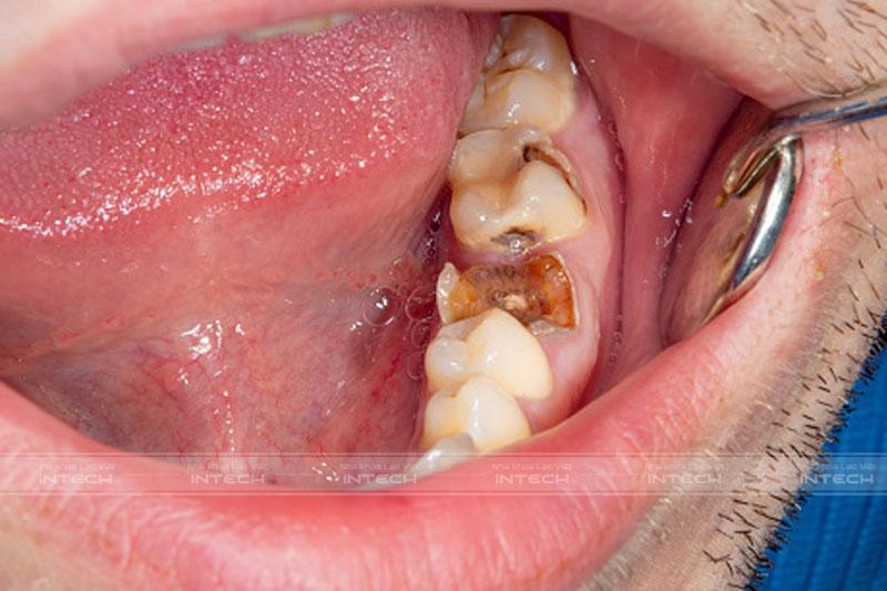 Trồng răng lấy tủy chỉ áp dụng đối với trường hợp răng trụ bị sâu, chấn thương nặng