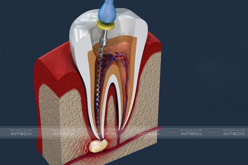 Trồng răng lấy tủy có thể gây biến chứng đau nhức nếu bác sĩ thực hiện tay nghề kém
