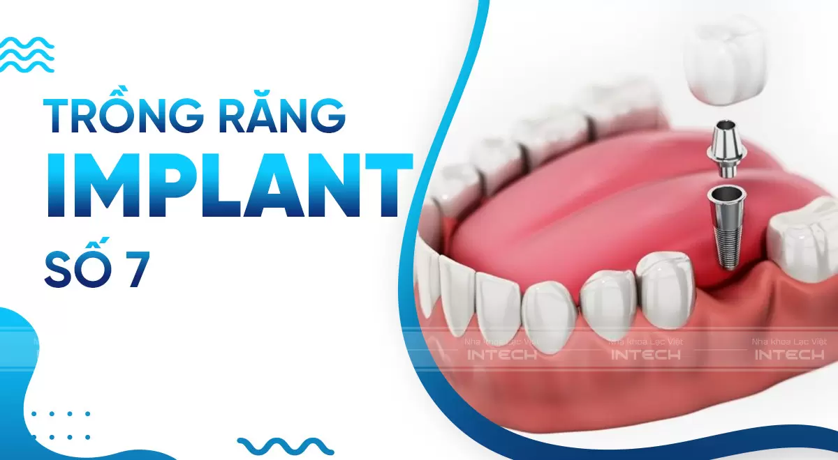 Phục hình răng 7 mất bằng trồng răng Implant