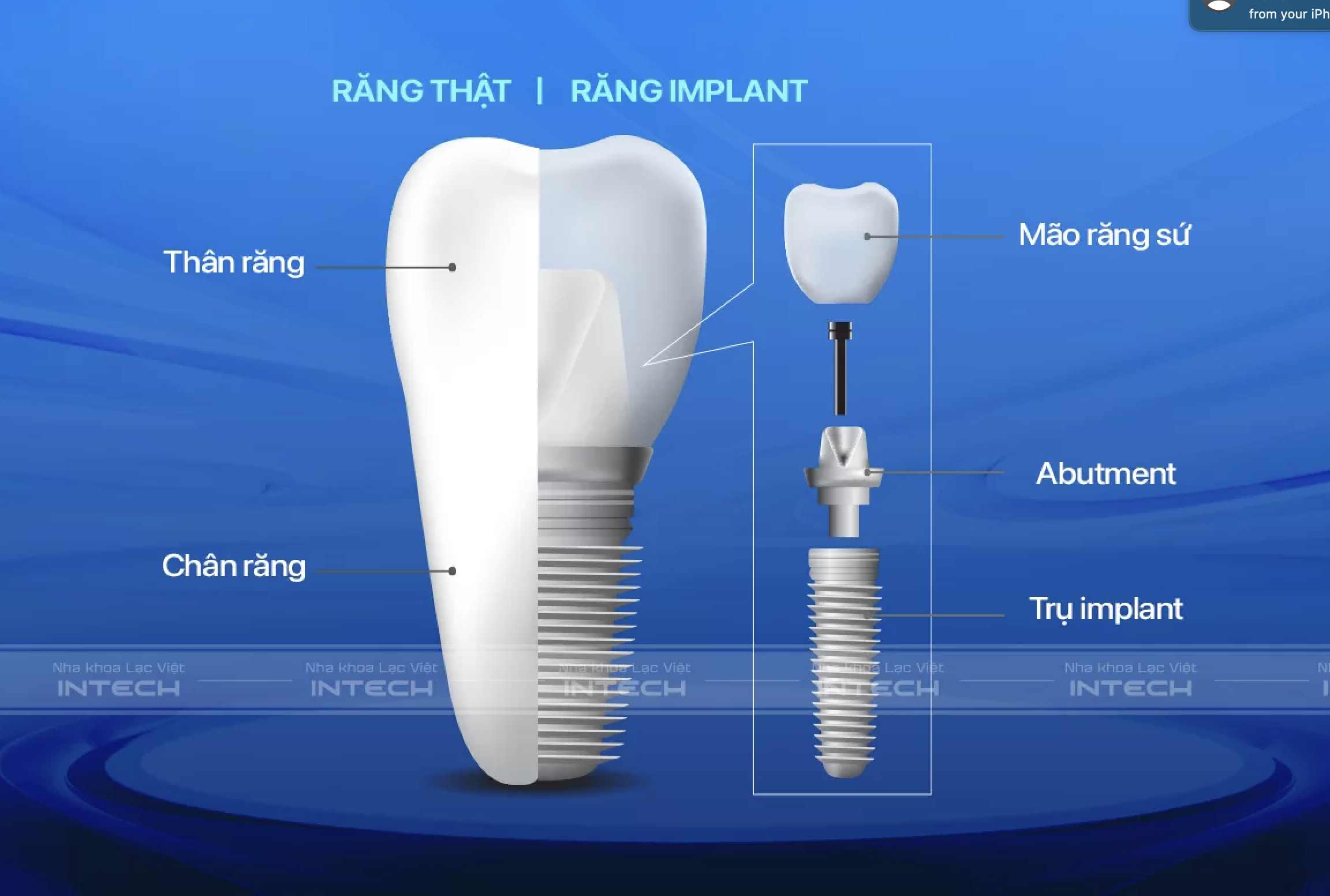 cấu tạo răng implant