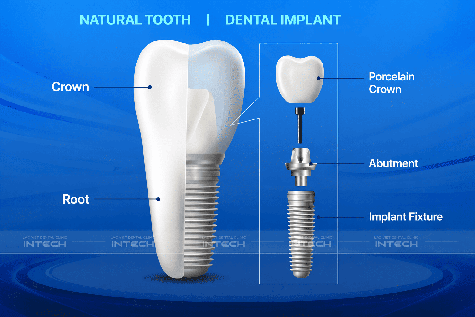 The difference between natural teeth and dental implants