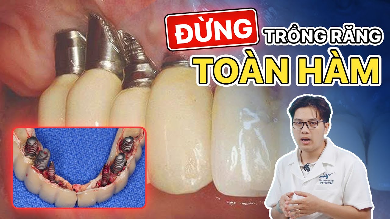 Trồng Răng Toàn Hàm: Đừng Làm Nếu Chưa Biết 3 Điều Nguy Hiểm Này!