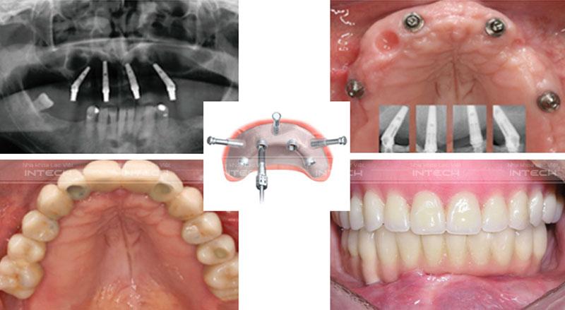 Với kỹ thuật trồng răng toàn hàm, răng Implant được cố định chắc chắn