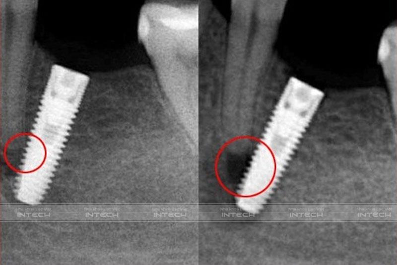 Trụ Implant cắm lệch vào chân răng bên cạnh
