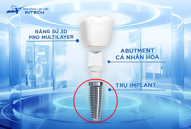 Trụ Implant cắm trực tiếp vào xương hàm, thay thế cho chân răng đã mất