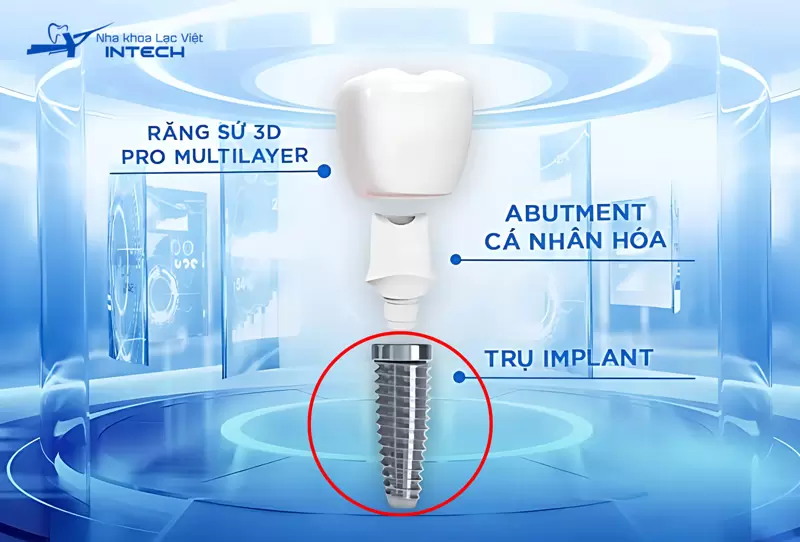 Chọn trụ implant chính hãng, nguồn gốc rõ ràng.