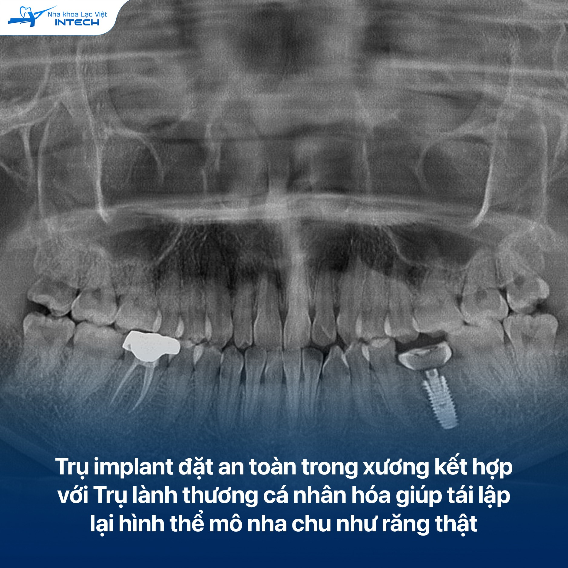 Trụ Implant đặt chính xác giúp đảm bảo khả năng ăn nhai như răng thật, hạn chế các vấn đề viêm nhiễm khi bị giắt thức ăn