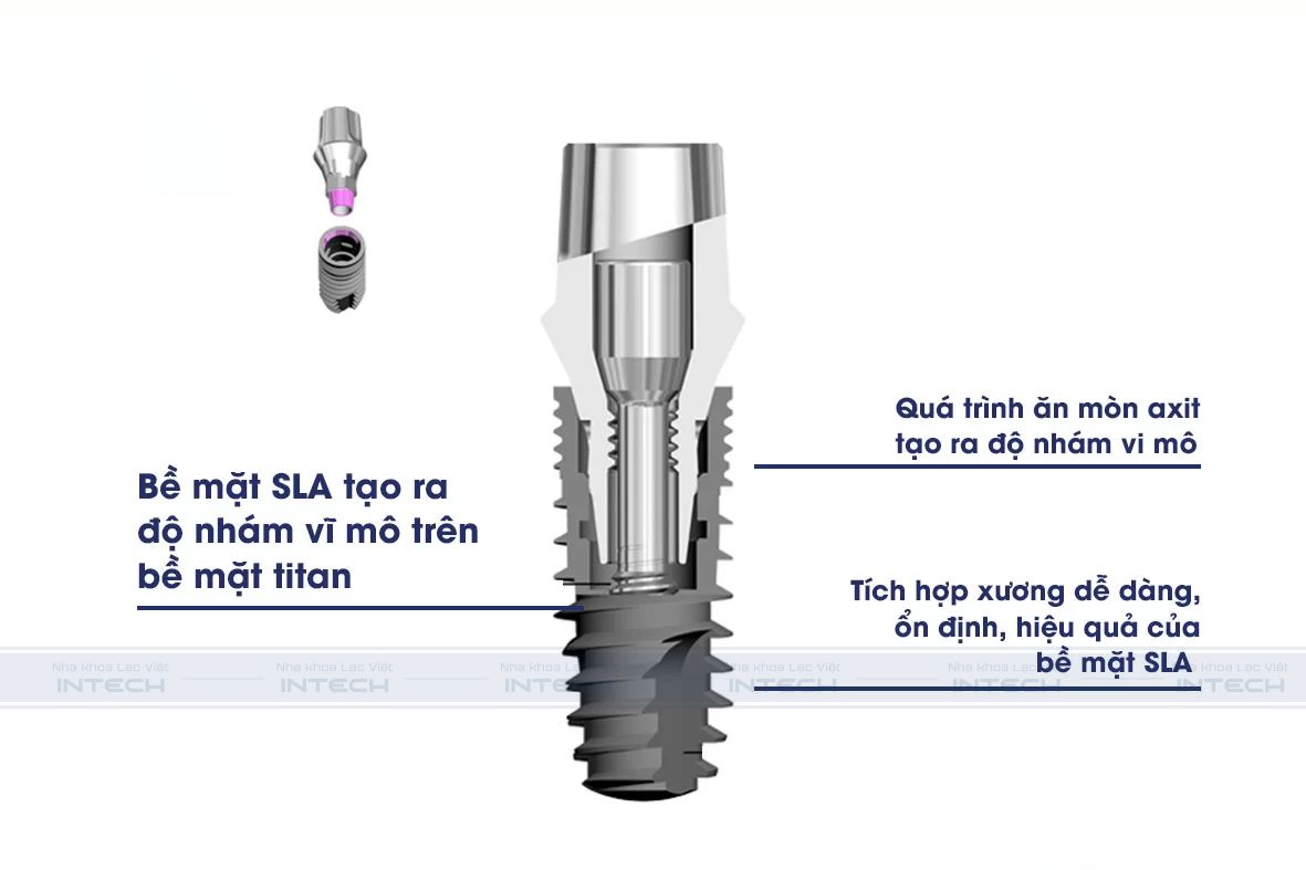 Trụ Implant được cắm trực tiếp vào xương hàm làm nhiệm vụ nâng đã trụ phục hình và mão răng sứ phía trên