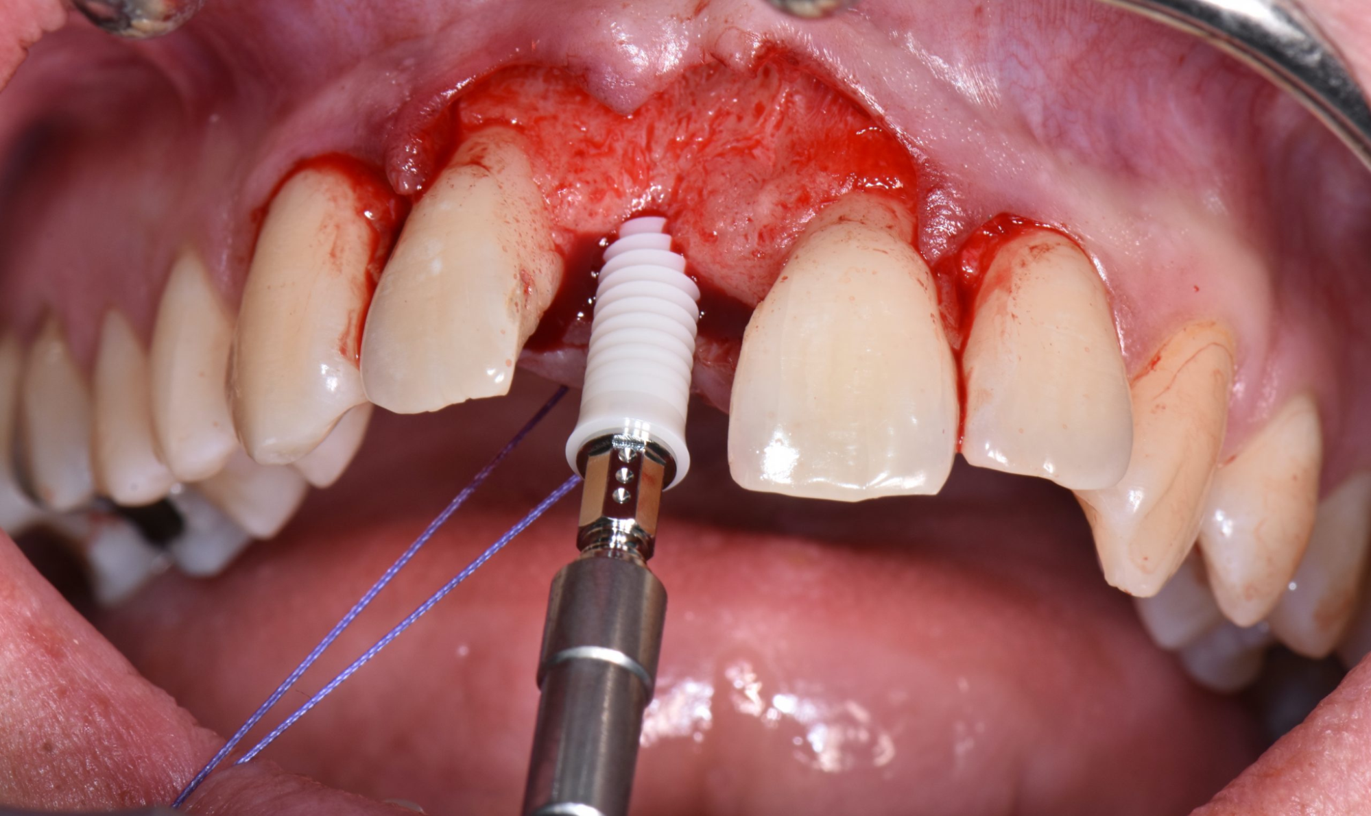 Trụ Implant được đặt vào lỗ chờ đã tạo bằng các phương pháp đặt trụ khác nhau